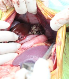 内側・外側左葉の肝臓腫瘍を摘出